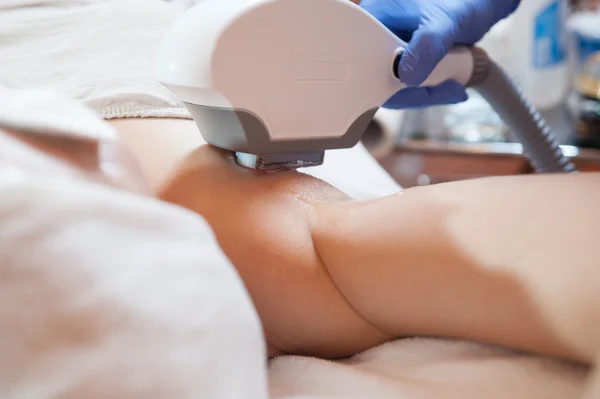 Laser epilation, laser depilation — Stock fotografie