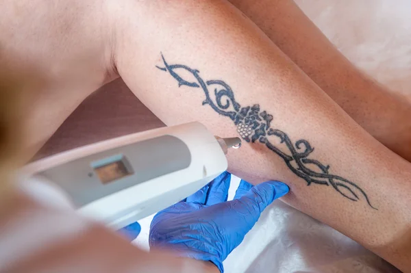 Remoção de tatuagem, corpo, perna , — Fotografia de Stock