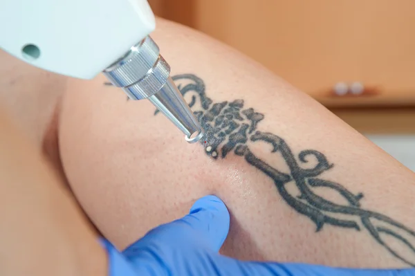 Tattoo removal, body, leg, — Stock Photo, Image