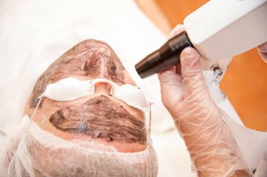 karbon lazer tedavisi cilt / lazer tedavisi