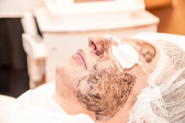 karbon lazer tedavisi cilt / lazer tedavisi