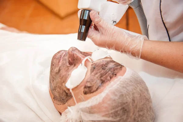 Uhlíku laserové ošetření kůže / laserové ošetření — Stock fotografie