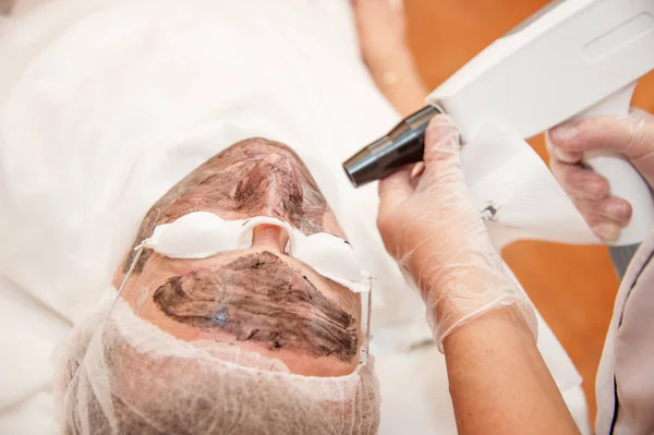 Uhlíku laserové ošetření kůže / laserové ošetření — Stock fotografie