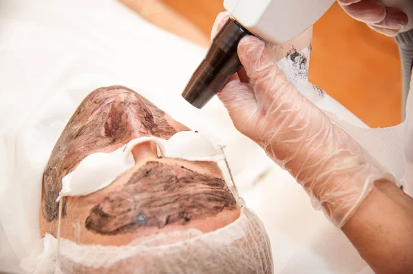 karbon lazer tedavisi cilt / lazer tedavisi