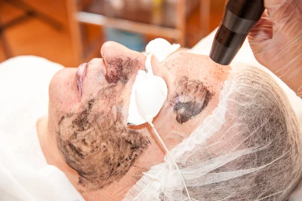 Uhlíku laserové ošetření kůže / laserové ošetření — Stock fotografie