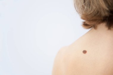 Bir tıbbi Danışma Nevusu, kaldırılması, doğum lekesi