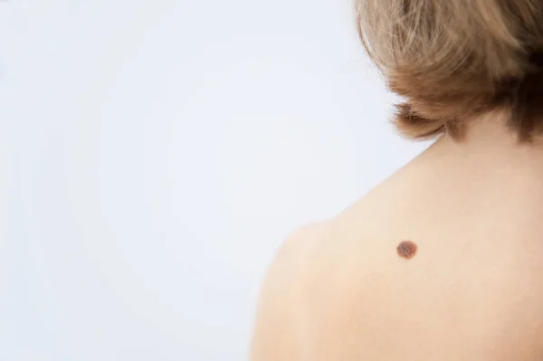 Bir tıbbi Danışma Nevusu, kaldırılması, doğum lekesi