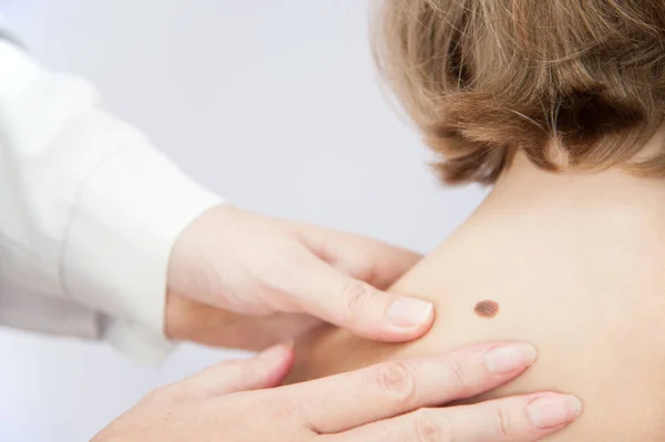 Bir tıbbi Danışma Nevusu, kaldırılması, doğum lekesi