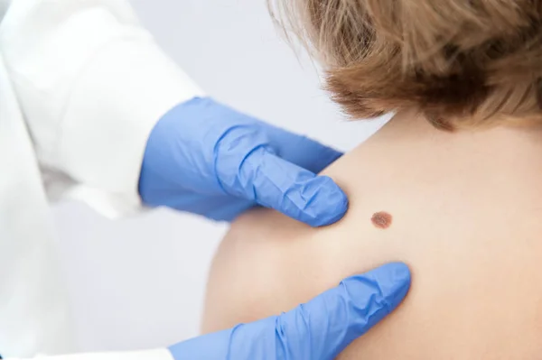 Bir tıbbi Danışma Nevusu, kaldırılması, doğum lekesi