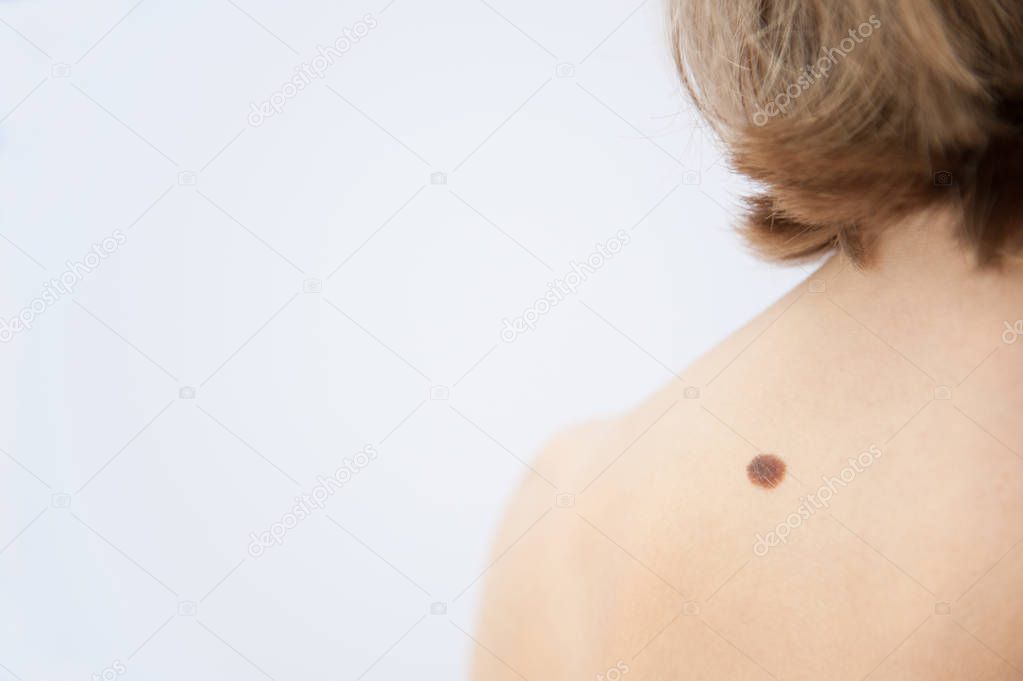 A medical consultation at the Removal of nevus, birthmark