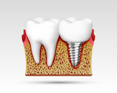 bir kesim sinir uçları ile 3D dişlerde.