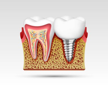 bir kesim sinir uçları ile 3D dişlerde.
