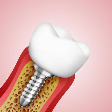 bir kesim sinir uçları ile 3D dişlerde.