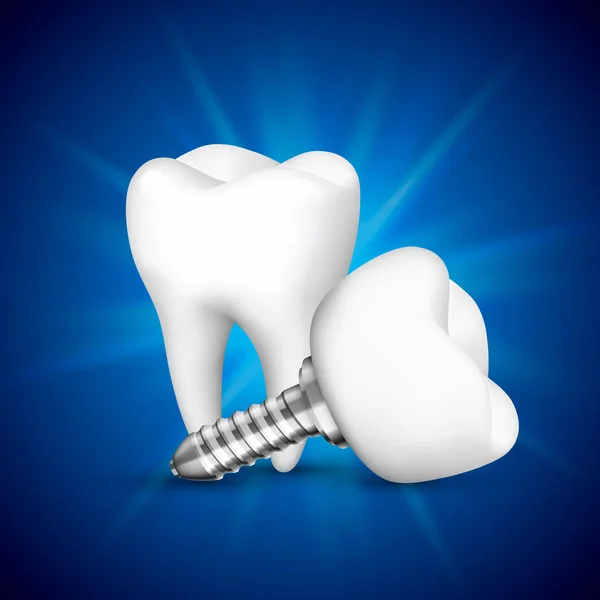 Implants dentaires sur fond bleu . — Image vectorielle