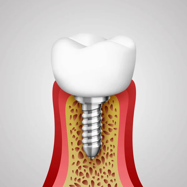 3d dentes em um corte com terminações nervosas . — Vetor de Stock