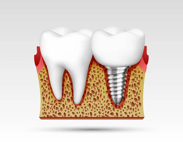 Dientes 3d en un corte con terminaciones nerviosas . — Vector de stock