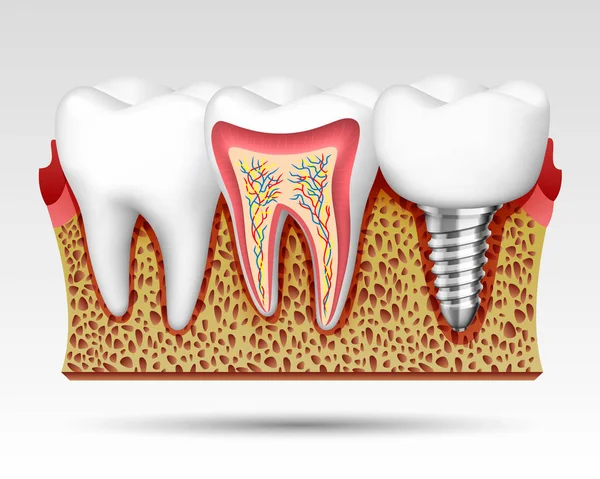 3d teeth in a cut with nerve endings. — Stock Vector