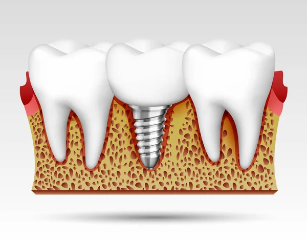 3D tänder i en nedskärning med nervändar. — Stock vektor