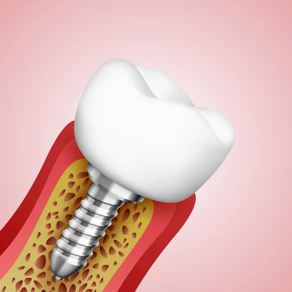 3d dentes em um corte com terminações nervosas . — Vetor de Stock