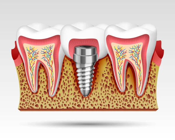 3d dentes em um corte com terminações nervosas . —  Vetores de Stock
