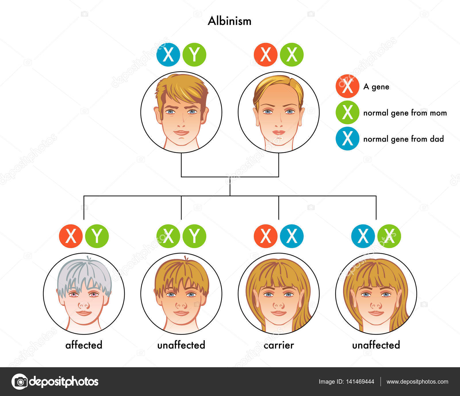 Distúrbio Genético Do Albinismo Ocular Caracterizado Por Pelo Da Pele E  Hipopigmentação Ocular Devido a Redução Ou Ausência Ilustração Stock -  Ilustração de causa, albinismo: 283553110, image size:1600x1376