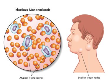 symptoms of infectious mononucleosis clipart
