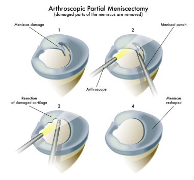  operation of a arthroscopic partial meniscectomy. clipart