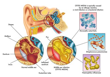 otitis media belirtileri