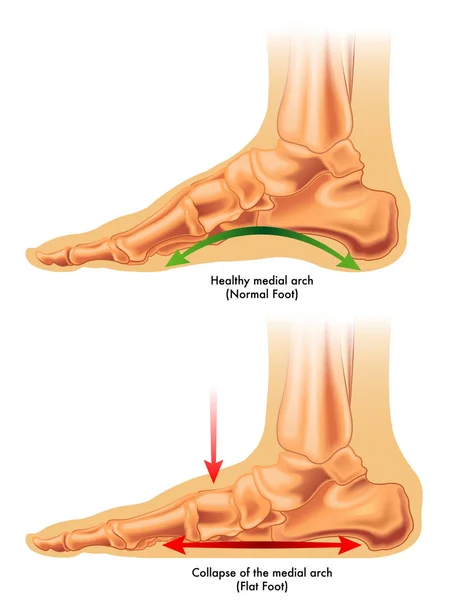 Consequences of flat foot — Stock Vector