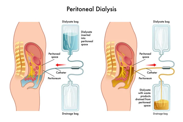 Periton diyalizi prosedürü. — Stok Vektör