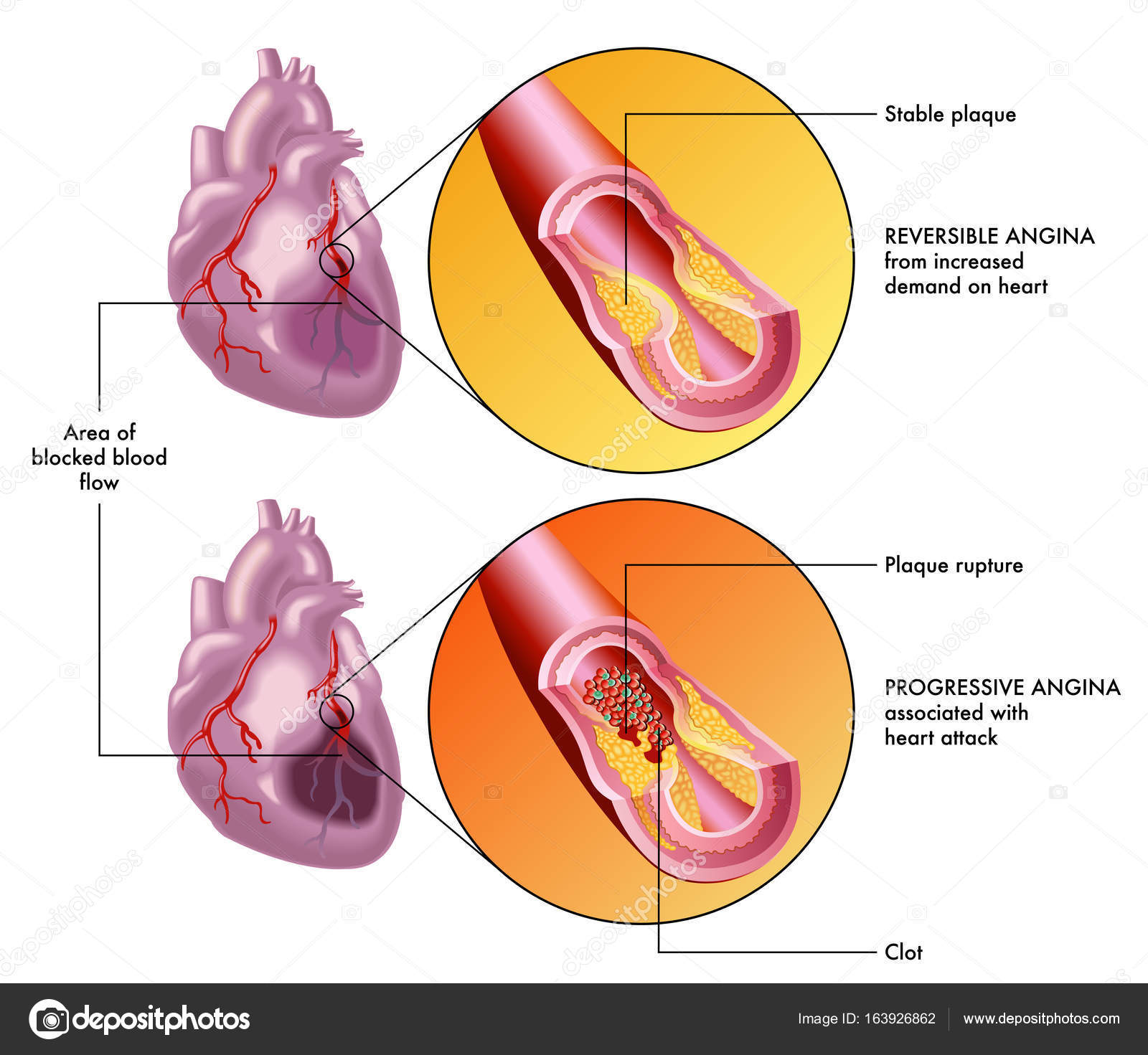 Angina pectoris 32 Angina pectoris 78