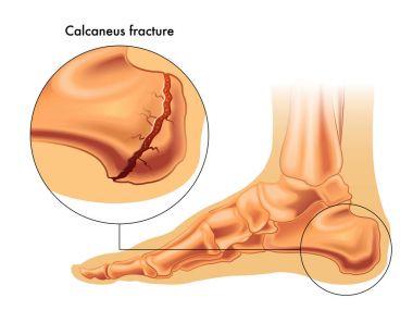 calcaneus kırık illüstrasyon 
