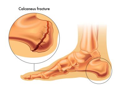 calcaneus fracture illustration  clipart