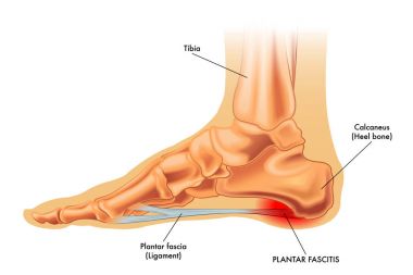 plantar fascitis illustration