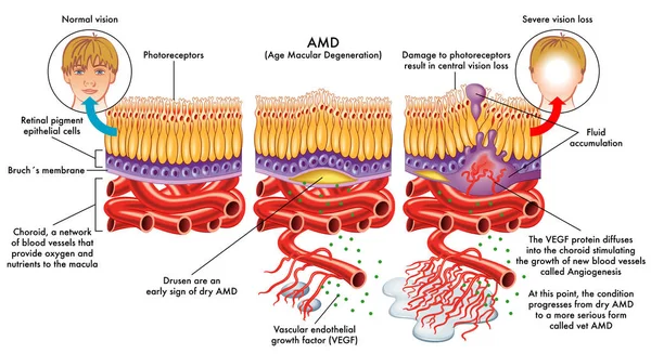 Edad degeneración macular — Vector de stock