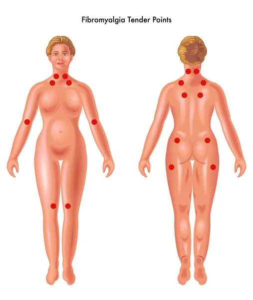 Fibromyalgie Points sensibles — Image vectorielle