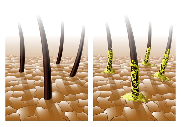 yağlı saç illüstrasyon