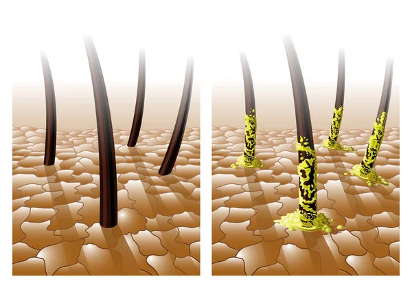 Жирні волосся ілюстрація — стоковий вектор