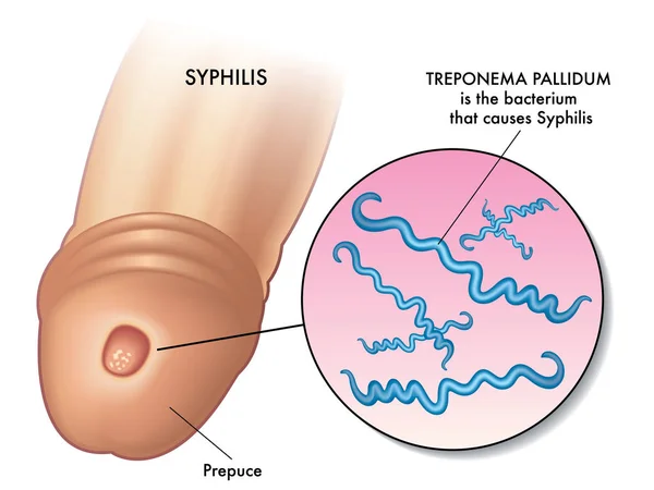 Illustration Syphilis-Infektion — Stockvektor