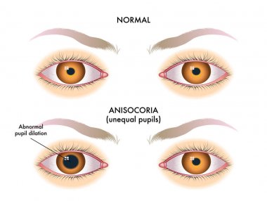 vektör çizim anisocoria. öğrenciler farklı boyutta 