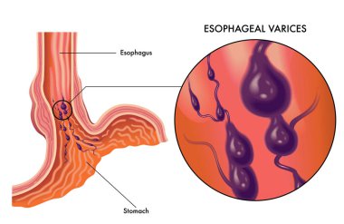 Vector illustration of human Esophageal carcinoma on white background   clipart