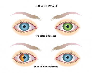 İnsan gözü hetrokromya, vektör çizim ile