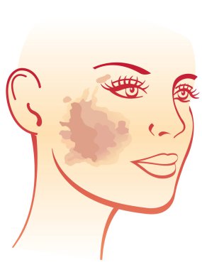 Melanoma on the cheek of woman , vector illustration clipart