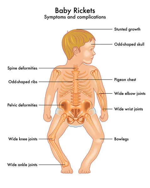 Συμπτώματα Και Επιπλοκές Της Ραχίτιδας Μωρό Εικονογράφηση Διάνυσμα — Διανυσματικό Αρχείο