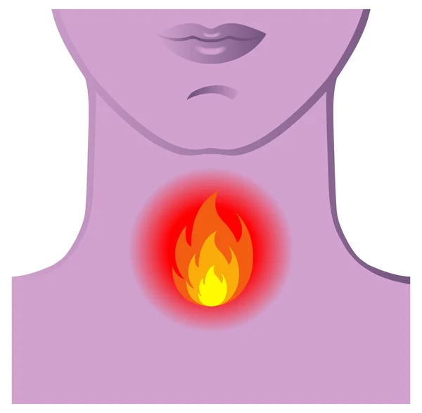 Human Burning Throat Vector Illustration — Stock Vector