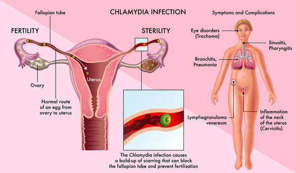 chlamydia infection medical poster, vector illustration