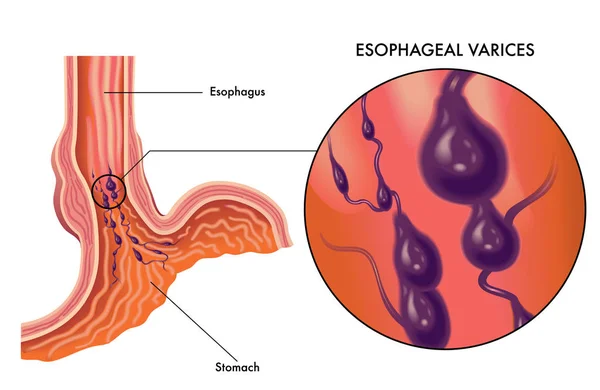 Ilustración Vectorial Del Carcinoma Esofágico Humano Sobre Fondo Blanco — Vector de stock