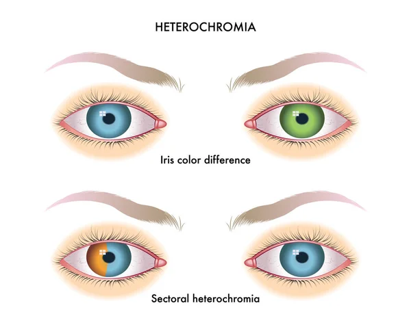 Lidské Oči Heterochromie Vektorové Ilustrace — Stockový vektor