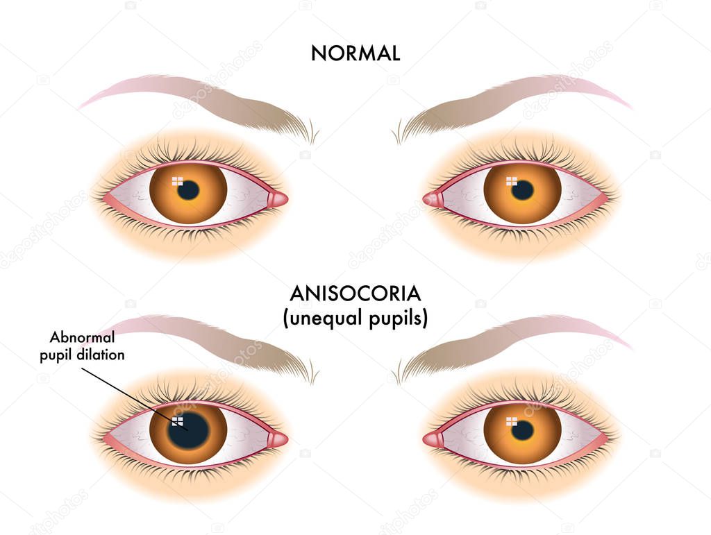 Vector illustration of anisocoria. pupils of different size 