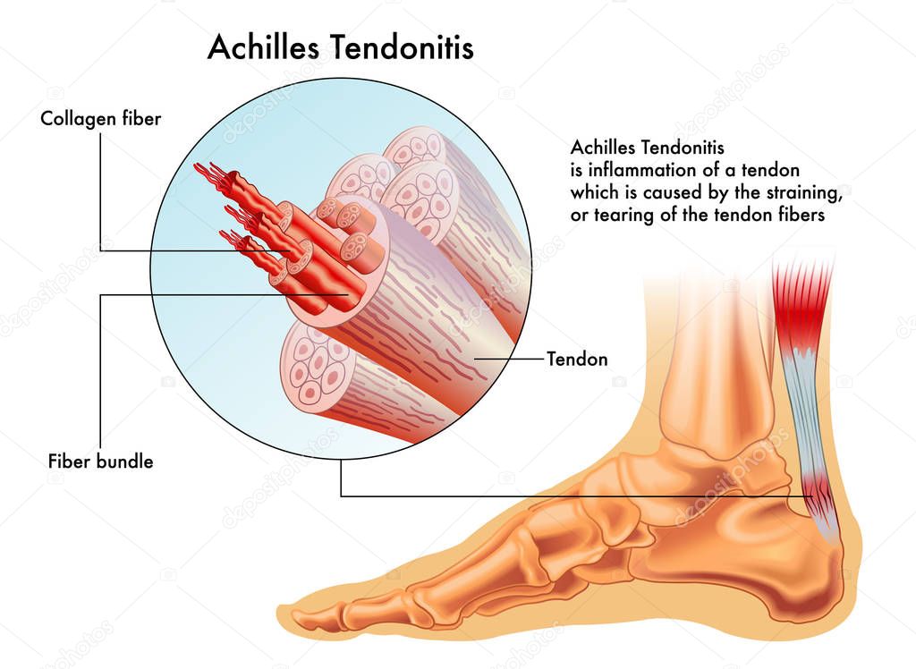 Vector illustration of achilles tendon, image of foot anatomy with all tendons and bones 